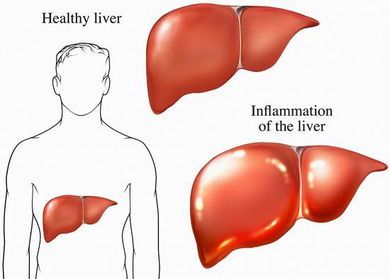五个信号说明肝脏受损，要警惕！