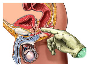 让人闻之色变的直肠指检 又难受又没用？
