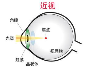 戴眼镜会让眼睛近视度数加深吗？